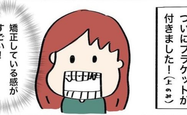「これぞ矯正…！」ついにワイヤー装着。気になる装着感は…？ #歯列矯正はじめました 13