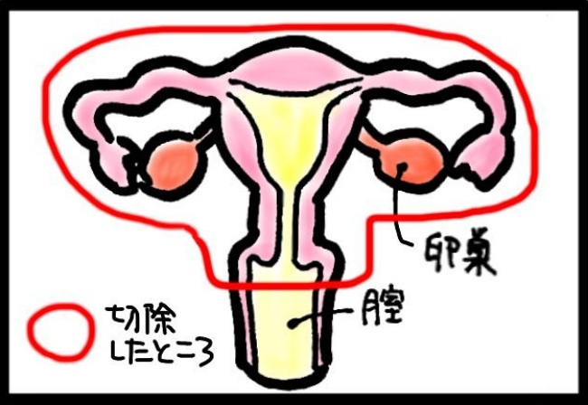 「ハァハァ…」子宮全摘の翌日、激痛で息ができない!姉にSOSを出すと…!? #子宮がんと腸閉塞 2