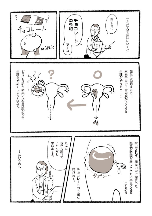 「テニスボールくらい」まさかの場所が腫れてる!?医師に告げられたのは… #チョコレートのう胞 1