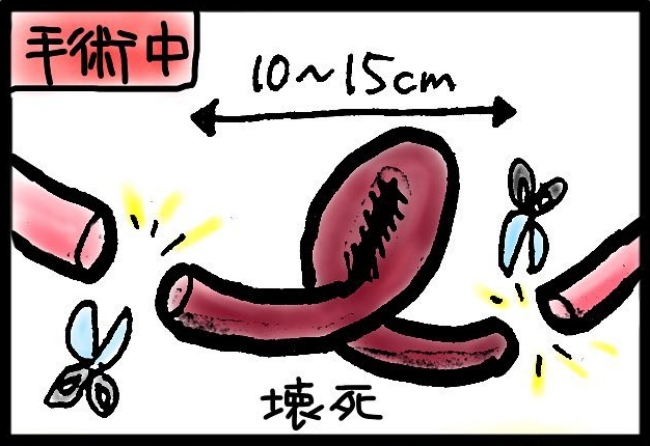 「まさか人生で3回もおなかを切るなんて」強烈な腹部の痛みの原因は? #子宮がんと腸閉塞 17