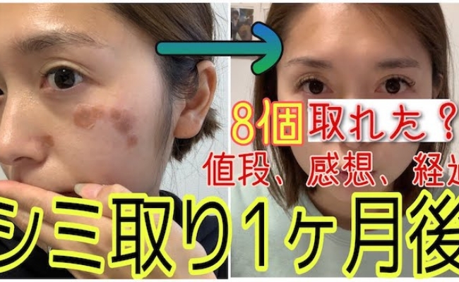 【27万回再生】シミ取りビフォーアフター！レーザー治療から1カ月後、濃いシミは取れた？