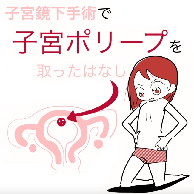 子宮鏡下手術で子宮ポリープを取ったはなし